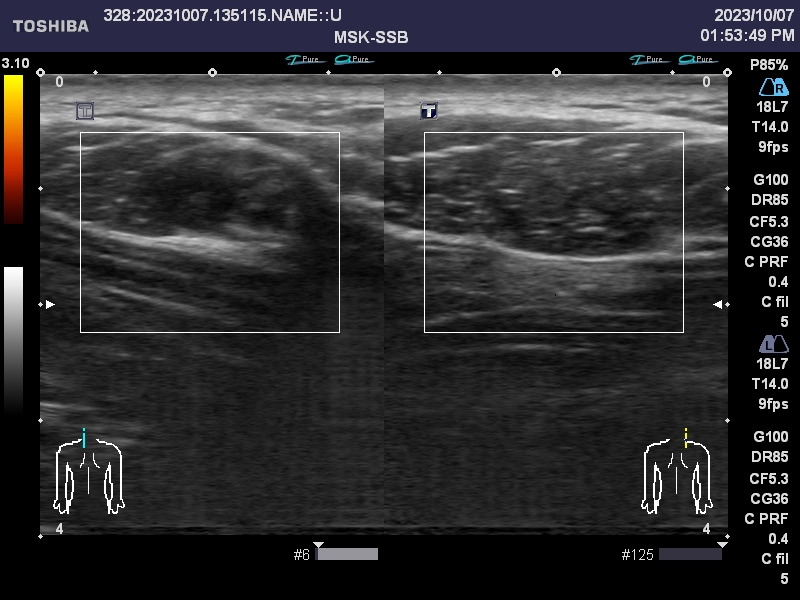 肩こりのエコー画像