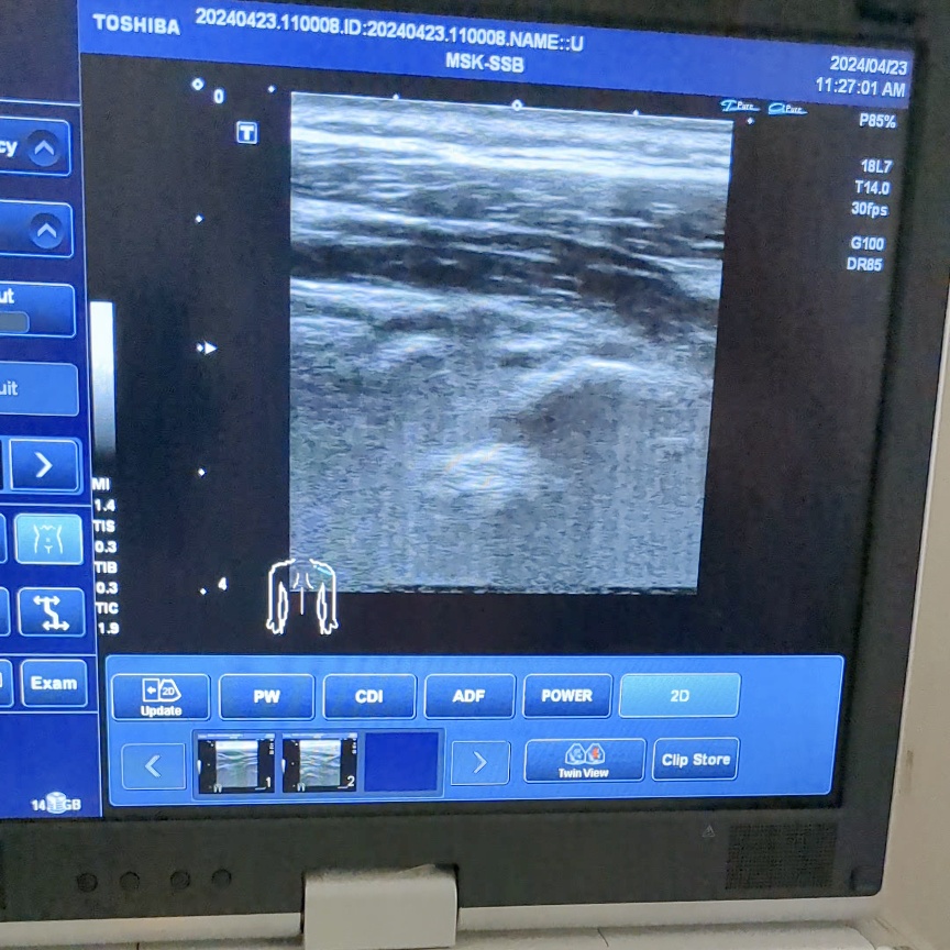 肩こりのエコー画像