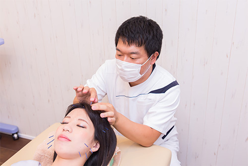 美容鍼はこんな方におすすめ!