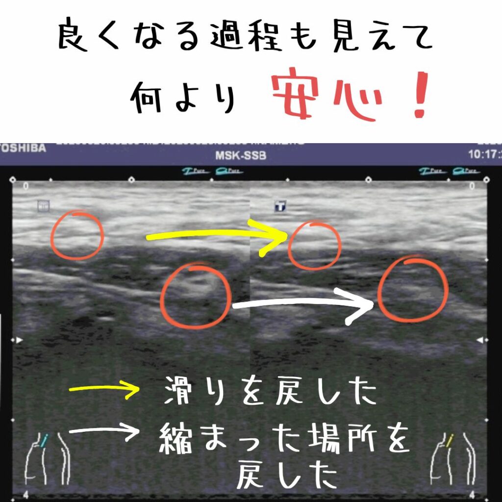 肩こりエコー画像での回復過程　肩こり鍼施術前と鍼施術後のエコー画像比較
