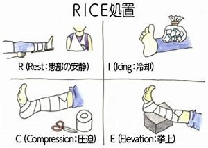 打撲でのｒｉｃｅ処置 エコーでの観察は吉岡鍼灸整骨院へ