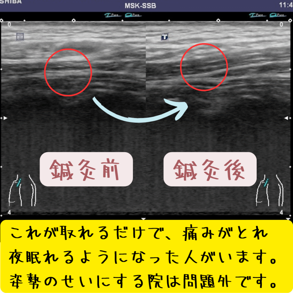 エコー画像による鍼灸前と鍼灸後の変化