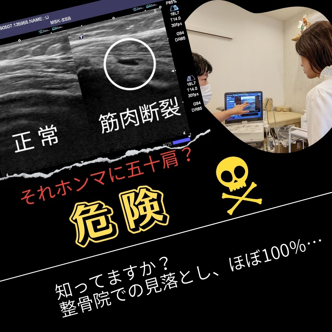 それ、本当に五十肩？エコーで確認しない整骨院では、重篤な症状を